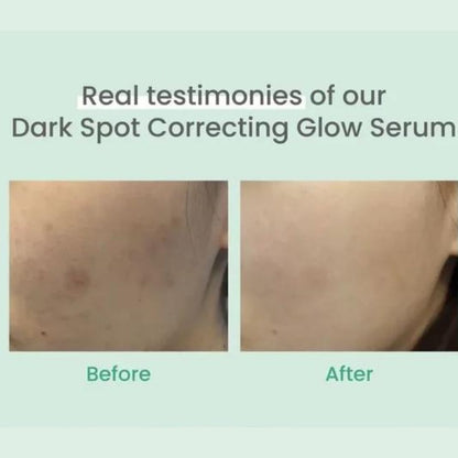 AXIS-Y Dark Spot Serum Before and After - Hyperpigmentation & Acne Scars