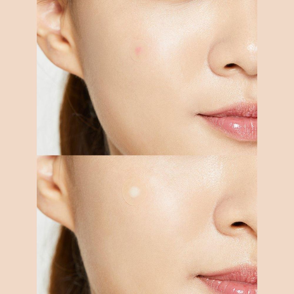 COSRX Acne Pimple Master Patch applied on model – ultra-thin, transparent acne treatment for discreet wear.